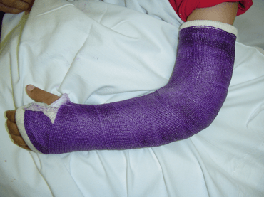 Distal Radius Fractures