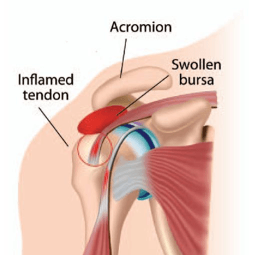 Shoulder Impingement pic
